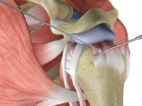 Rotator Cuff Repair