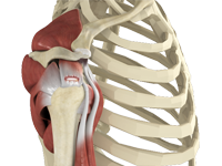 Rotator Cuff Tear