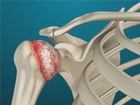 Shoulder Arthritis