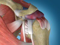 Shoulder Impingement