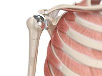 Shoulder Joint Replacement